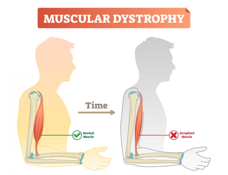 Muscular Dystrophy: What Causes This Disabling Condition?