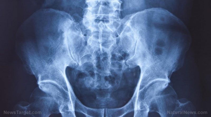 Increasing vitamin C intake can reduce hip fracture risk by 44 percent: Study