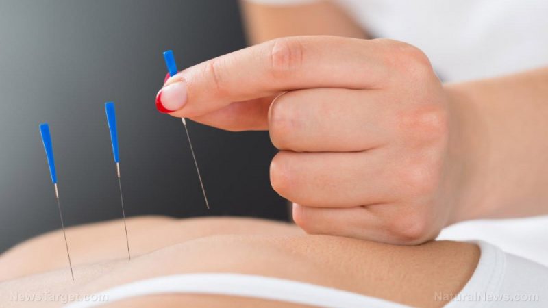 Warts can be cleared with acupuncture, study confirms