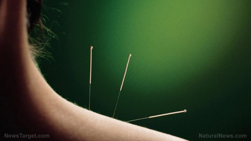 Acupuncture helps relieve stress, which is key to preventing psoriasis flares