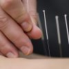 Acupuncture can do more than just relieve pain: It also improves quality of life