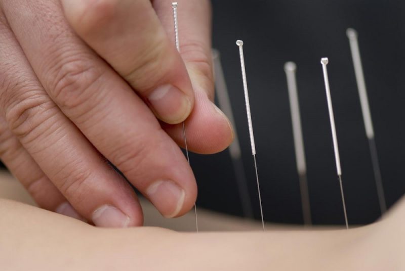 Acupuncture can do more than just relieve pain: It also improves quality of life