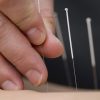 Review looks at the efficacy of acupuncture in treating insulin resistance