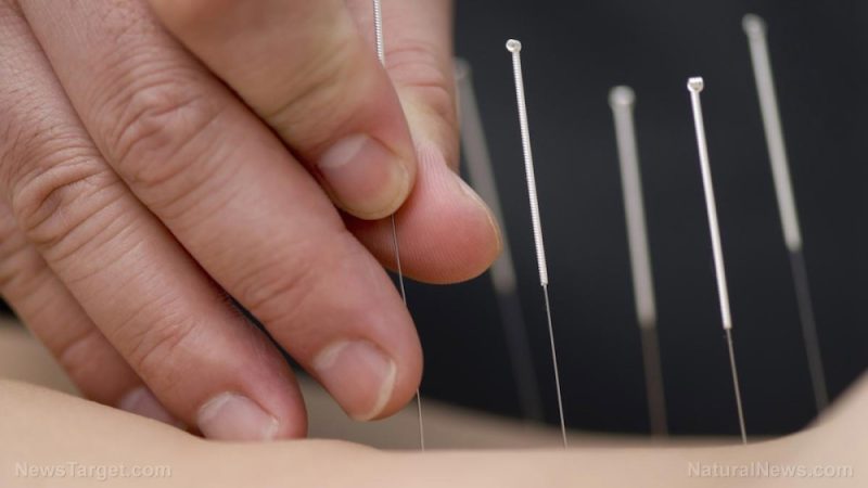 Review looks at the efficacy of acupuncture in treating insulin resistance